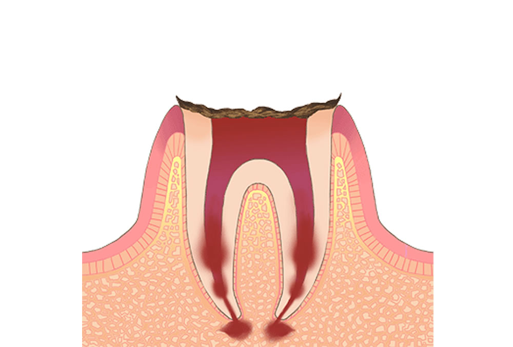 歯冠部分が崩壊した虫歯