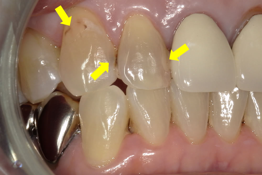 低侵襲な虫歯治療の症例