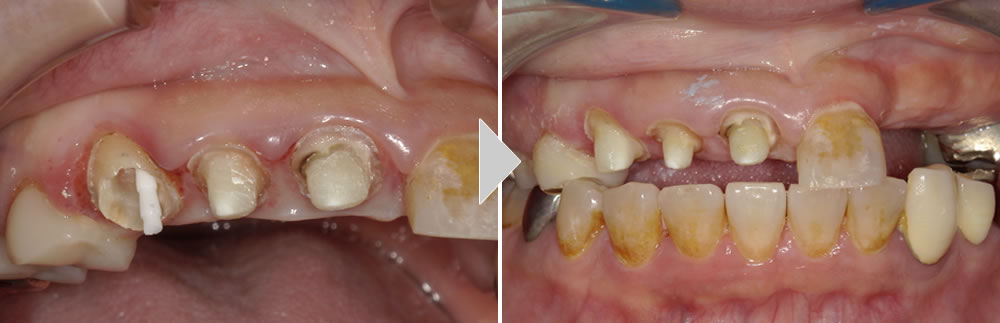 CAD/CAM冠と保険義歯による咬み合わせの回復症例