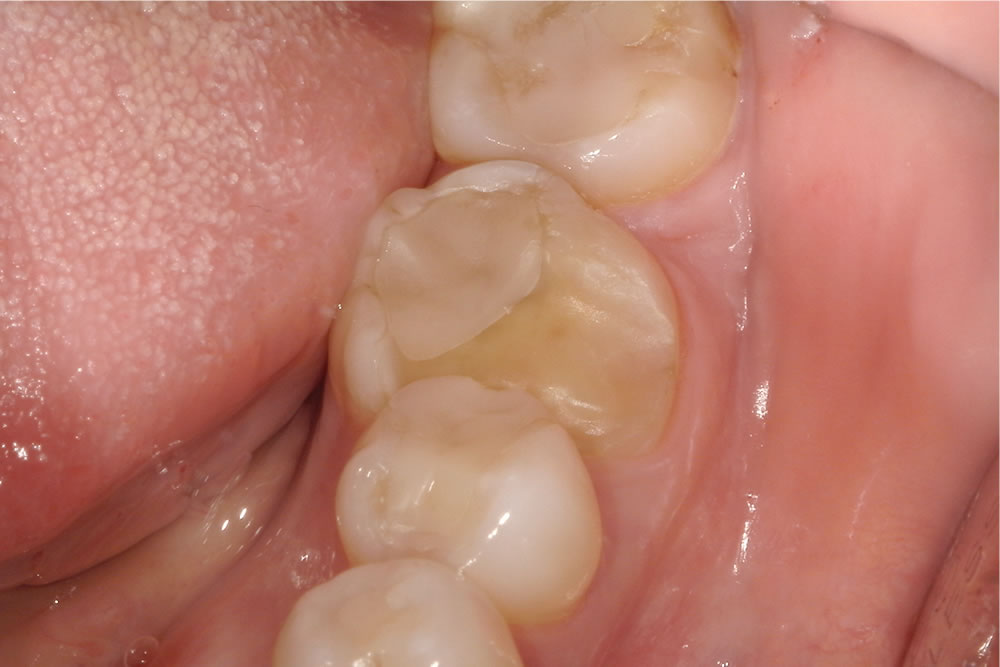セラミックインレーで歯を修復した症例