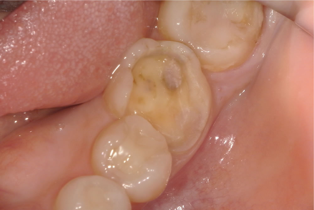 セラミックインレーで歯を修復した症例