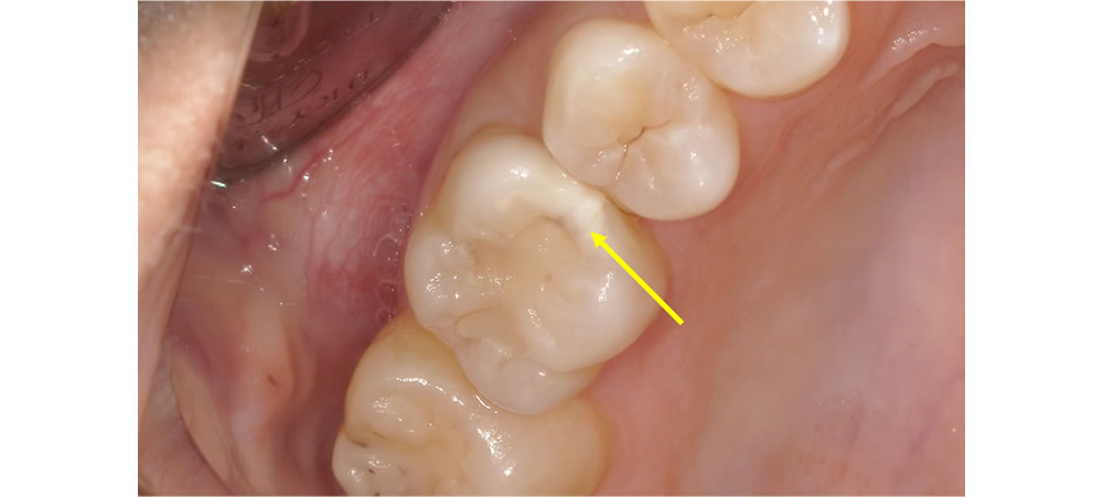 奥歯のセラミック治療症例