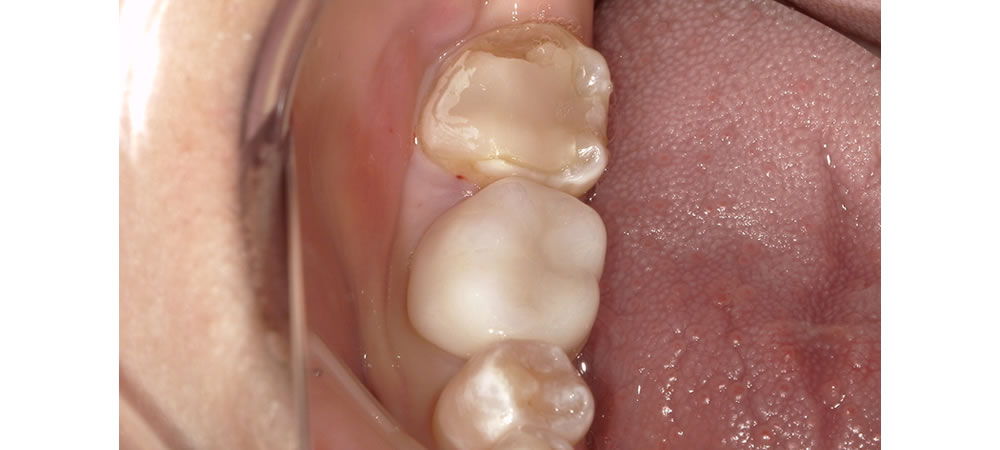 奥歯のセラミック治療症例