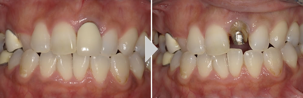 前歯のセラミック治療症例