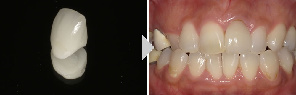 前歯のセラミック治療症例