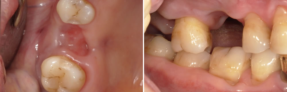 サ部分入れ歯による咬み合わせの回復症例