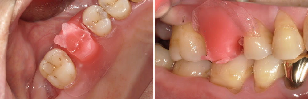 部分入れ歯による咬み合わせの回復症例