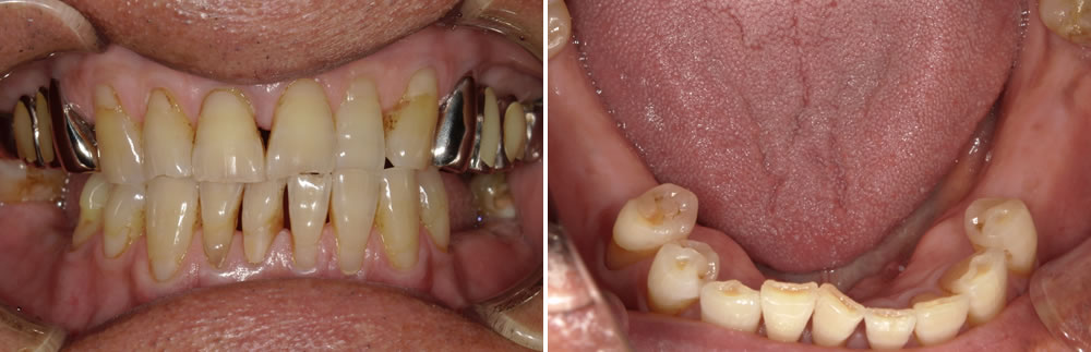 ノンクラスプデンチャー（義歯）で治療した症例