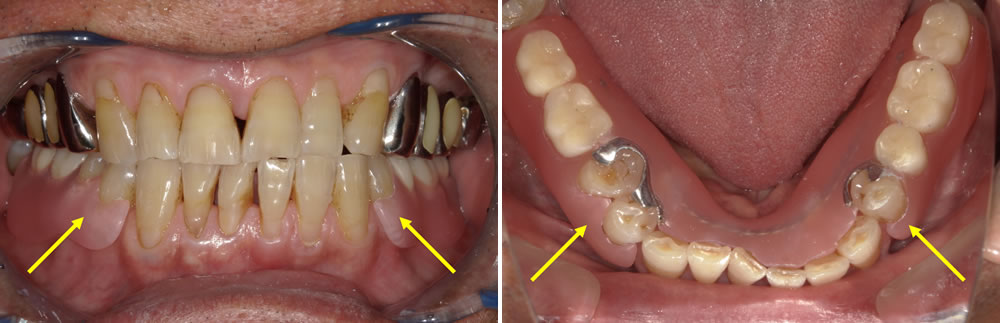 ノンクラスプデンチャー（義歯）で治療した症例