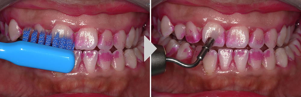 歯周病治療(歯石取り・クリーニング)