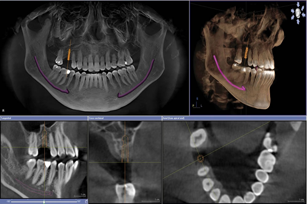 歯科用CTによる事前の精密検査